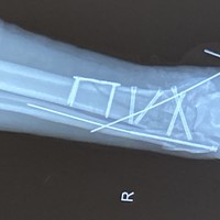 X-ray after 1st operation. 
